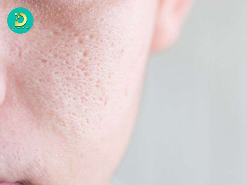 Lỗ chân lông giãn rộng