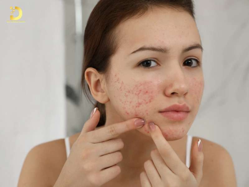 Mụn trứng cá viêm nặng là nguyên nhân hàng đầu gây sẹo đáy nhọn