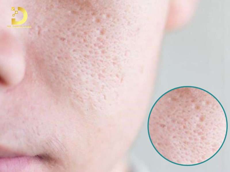 Nguyên nhân gây ra sẹo đáy vuông là gì