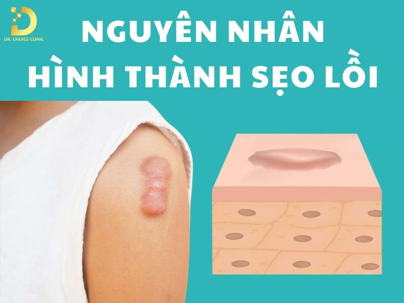 Nguyên nhân hình thành sẹo lồi