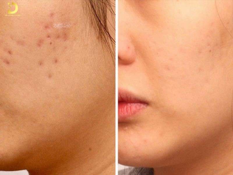 Những yếu tố ảnh hưởng đến khả năng tự phục hồi sẹo lõm sau thủy đậu là gì