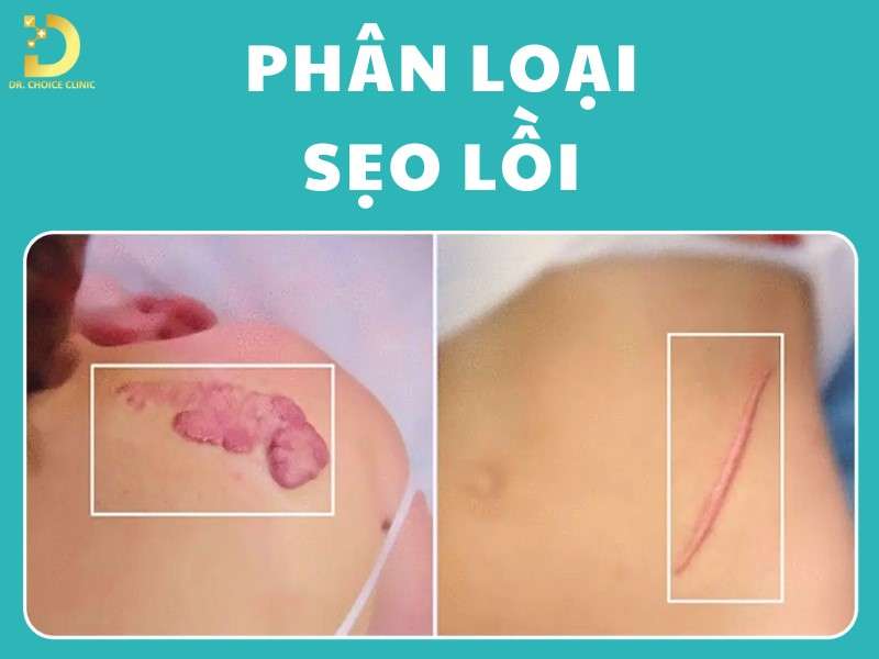 Phân loại sẹo lồi
