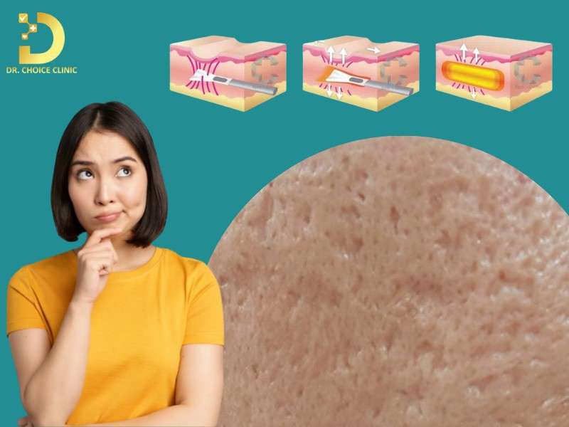 Các phương pháp điều trị sẹo đáy vuông 