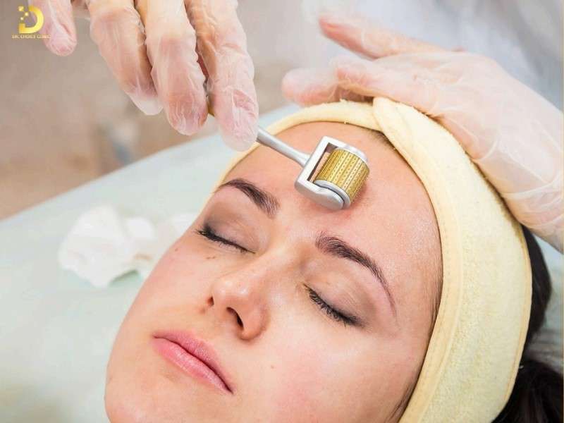 Top phương pháp điều trị sẹo lõm thủy đậu y khoa hiện đại