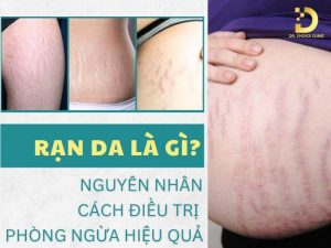 Rạn da là gì?