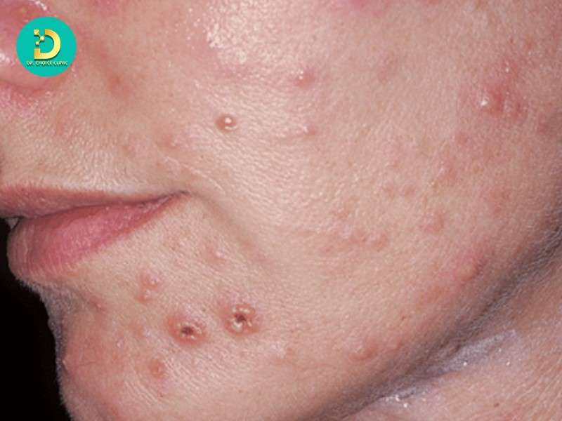 Sẹo đáy tròn do thủy đậu và các bệnh lý da