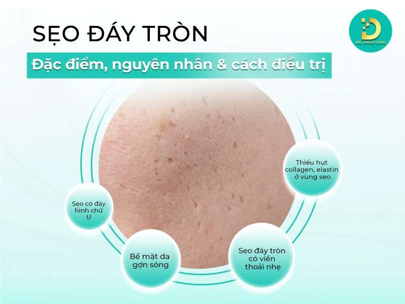 Sẹo đáy tròn