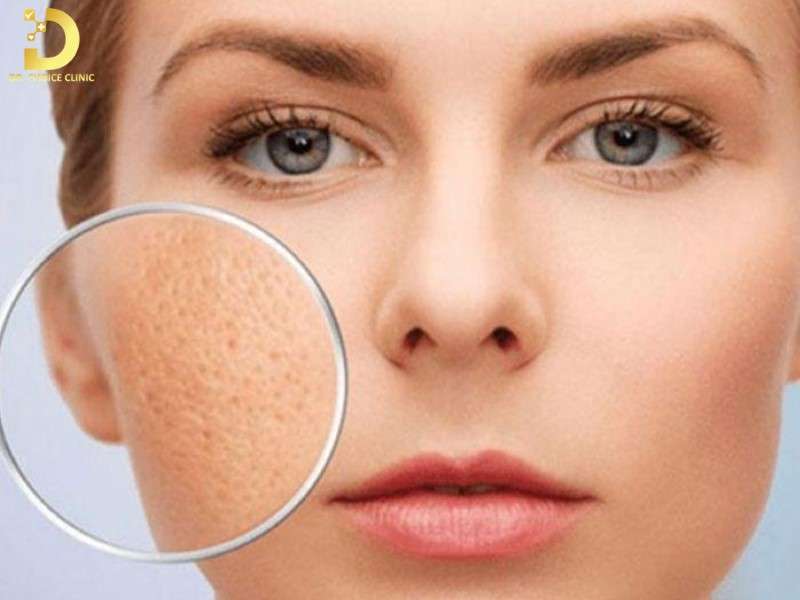 Hiểu hơn về sẹo đáy vuông là gì