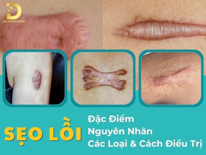 Sẹo lồi