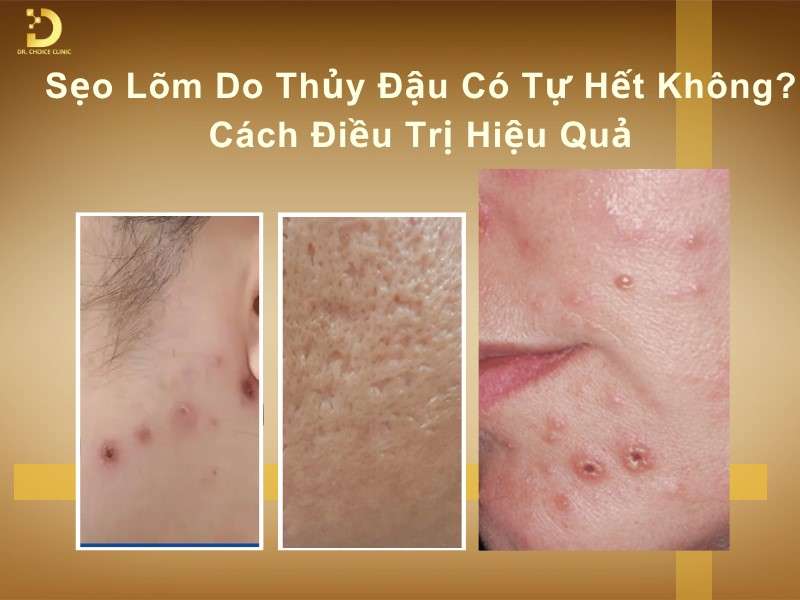 Sẹo lõm do thủy đậu có tự hết không?