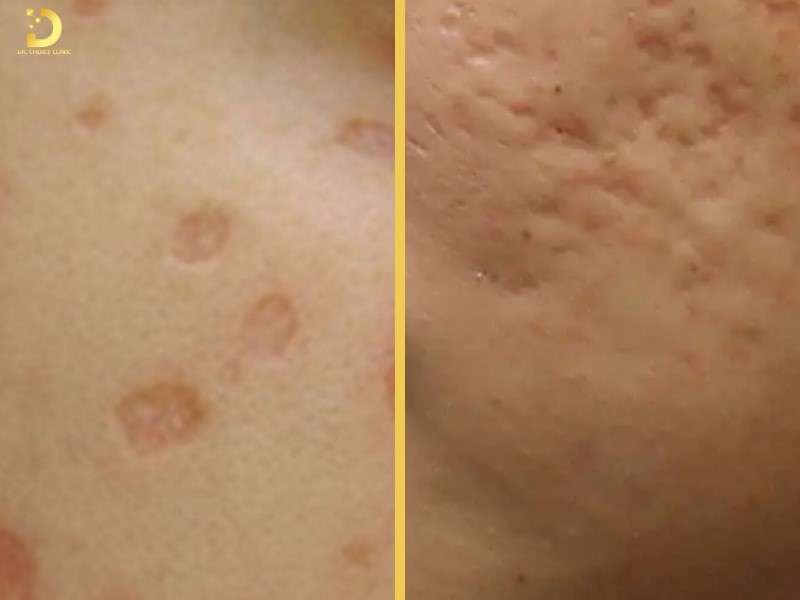 Sẹo lõm thủy đậu 