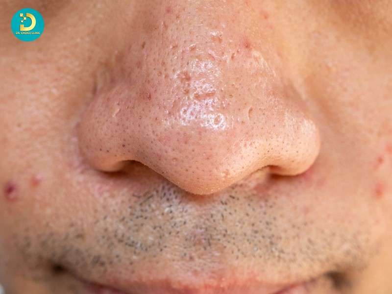 Sẹo Rỗ Ở Mũi: Nguyên Nhân & Cách Điều Trị Hiệu Quả 15 Sẹo rỗ do lỗ chân lông giãn rộng