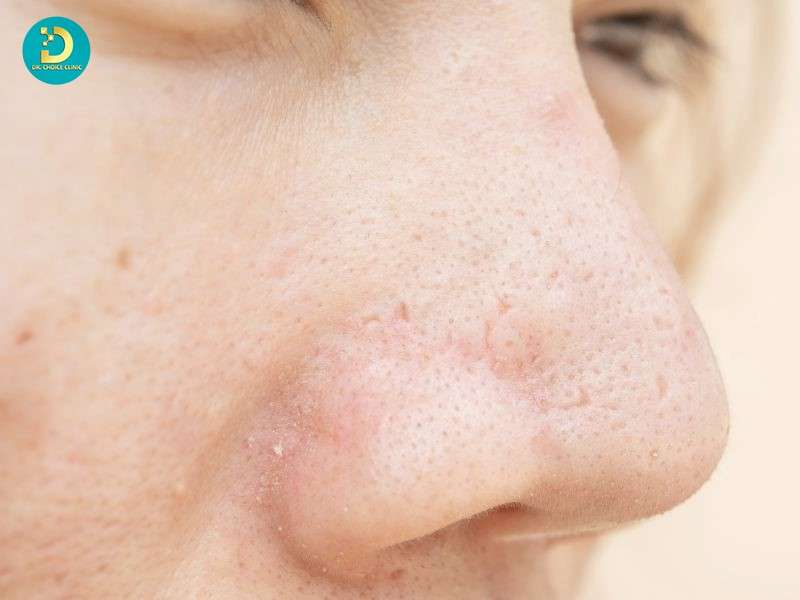 Sẹo Rỗ Ở Mũi: Nguyên Nhân & Cách Điều Trị Hiệu Quả 13 Sẹo rỗ ở mũi là gì?