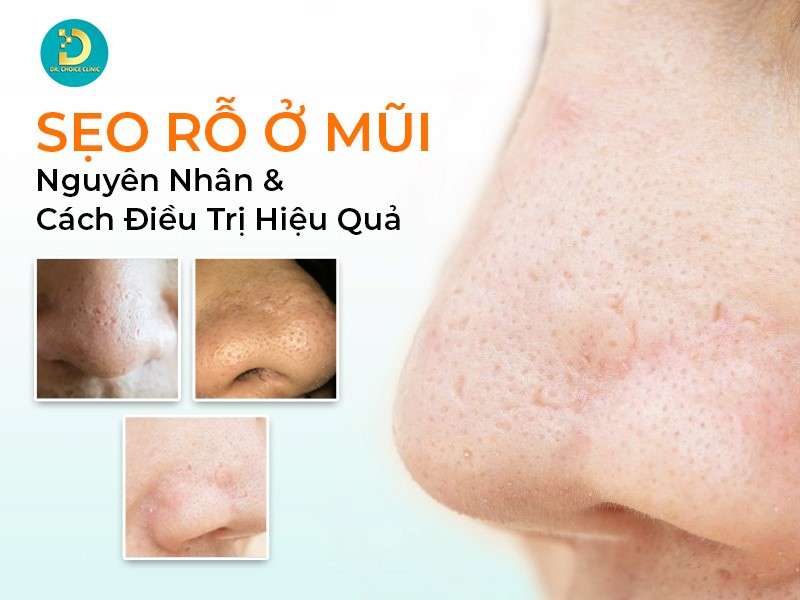 Sẹo Rỗ Ở Mũi: Nguyên Nhân & Cách Điều Trị Hiệu Quả 12 Sẹo rỗ ở mũi