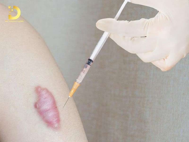 Tiêm Sẹo Lồi: Đặc Điểm, Công Dụng, Các Loại Và Lưu Ý Điều Trị 10 Tiêm sẹo lồi có công dụng và hạn chế