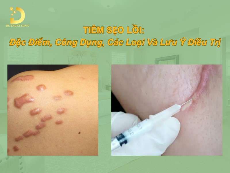 Tiêm Sẹo Lồi: Đặc Điểm, Công Dụng, Các Loại Và Lưu Ý Điều Trị 8 Tiêm sẹo lồi