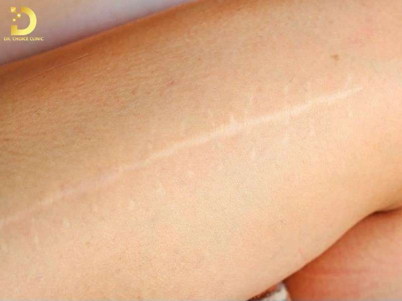 Yếu tố thúc đẩy hình thành sẹo trắng