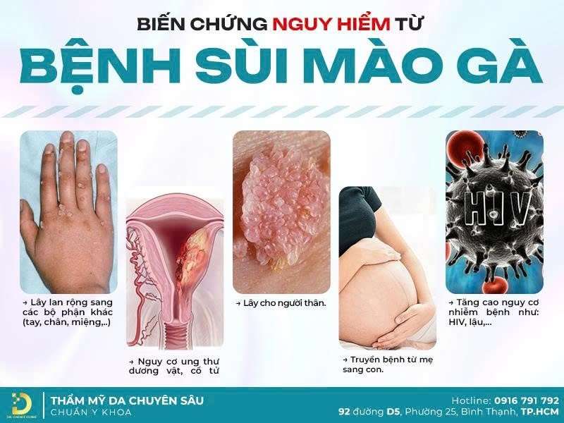 Biến chứng của sùi mào gà