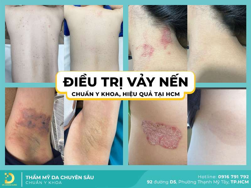 Điều Trị Vảy Nến Nhanh Chóng, Hiệu Quả HCM 9 Các phương pháp điều trị vảy nến theo chuẩn y khoa