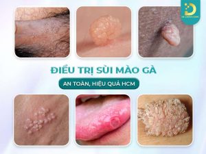 Điều trị sùi mào gà
