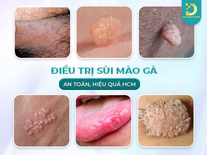 Điều trị sùi mào gà