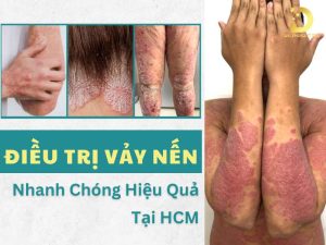 Điều trị vảy nến