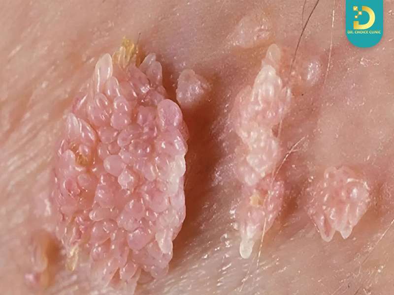 Sùi mào gà là gì?