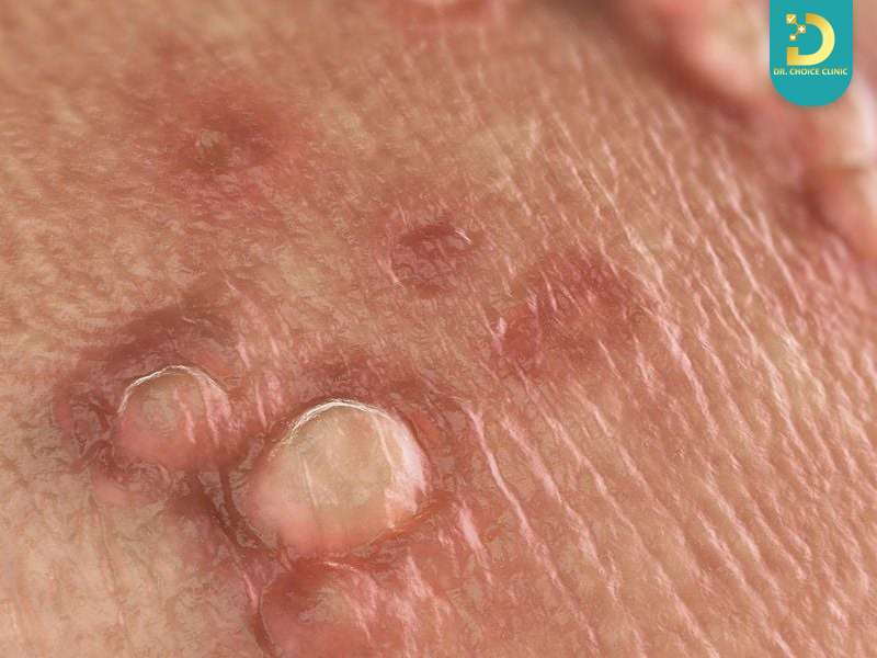 Triệu chứng và dấu hiệu nhận biết