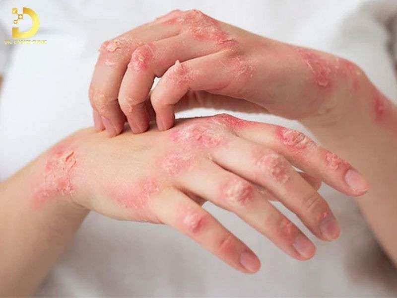 Bệnh viêm da cơ địa là gì và nguyên nhân khởi phát do đâu?