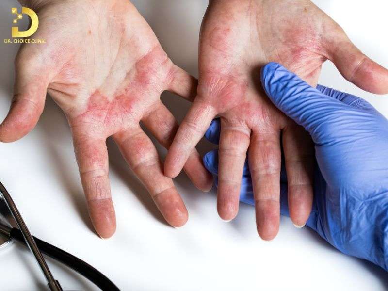 Các biện pháp phòng ngừa viêm da tái phát hiệu quả là gì?