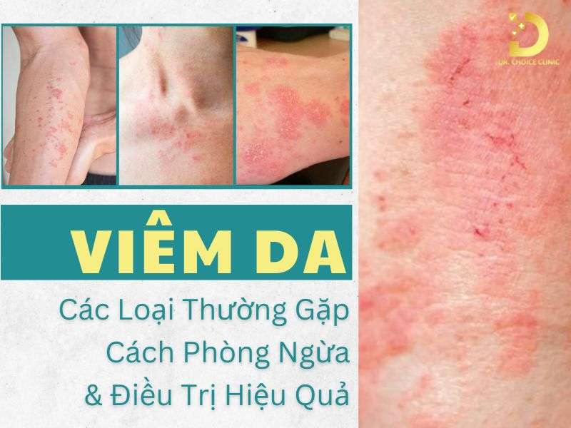 Các loại viêm da thường gặp