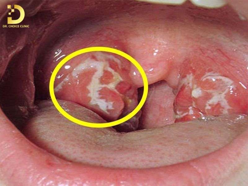 Cách phân biệt sùi mào gà với các bệnh lý vùng họng phổ biến