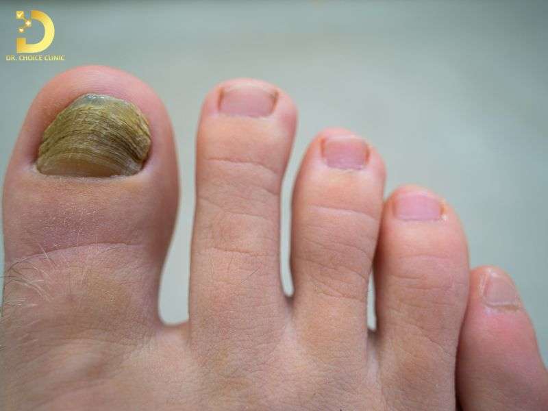 Nấm Móng: Triệu Chứng, Nguyên Nhân & Cách Điều Trị Hiệu Quả 8 Cảm giác đau nhức và các triệu chứng khó chịu đi kèm