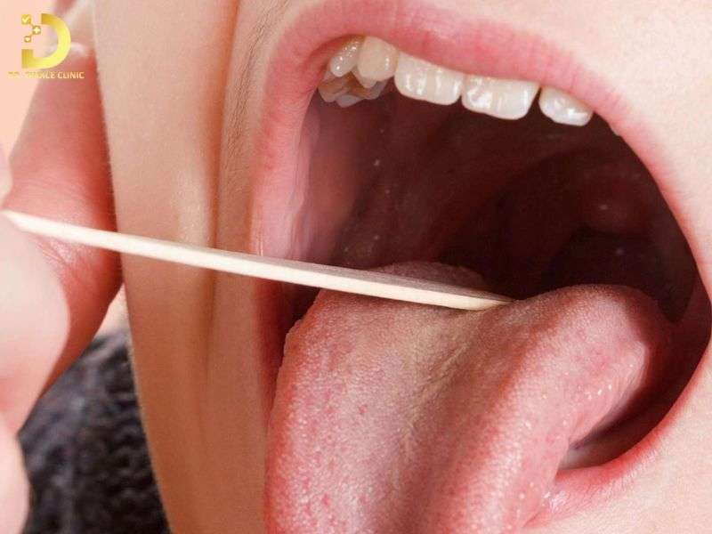 Chế độ chăm sóc hậu phẫu và phòng ngừa tái phát sùi mào gà trong họng