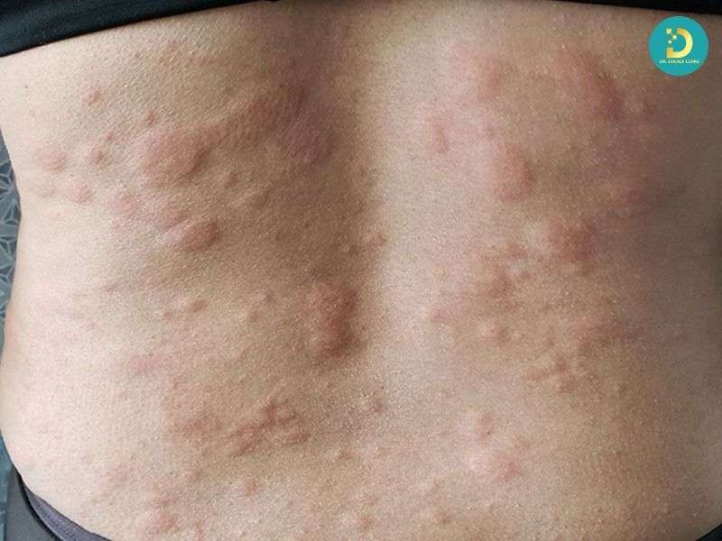 Cơ chế bệnh sinh của nổi mề đay