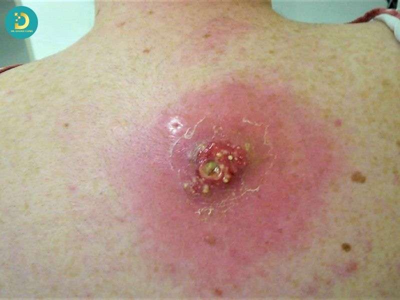 Cơ chế hình thành nhiễm trùng da