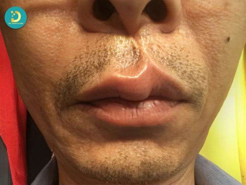 Môi Bị Sẹo Lồi Phải Làm Sao? Nguyên Nhân & Cách Điều Trị Hiệu Quả 12 Đặc điểm nhận biết sẹo lồi ở môi