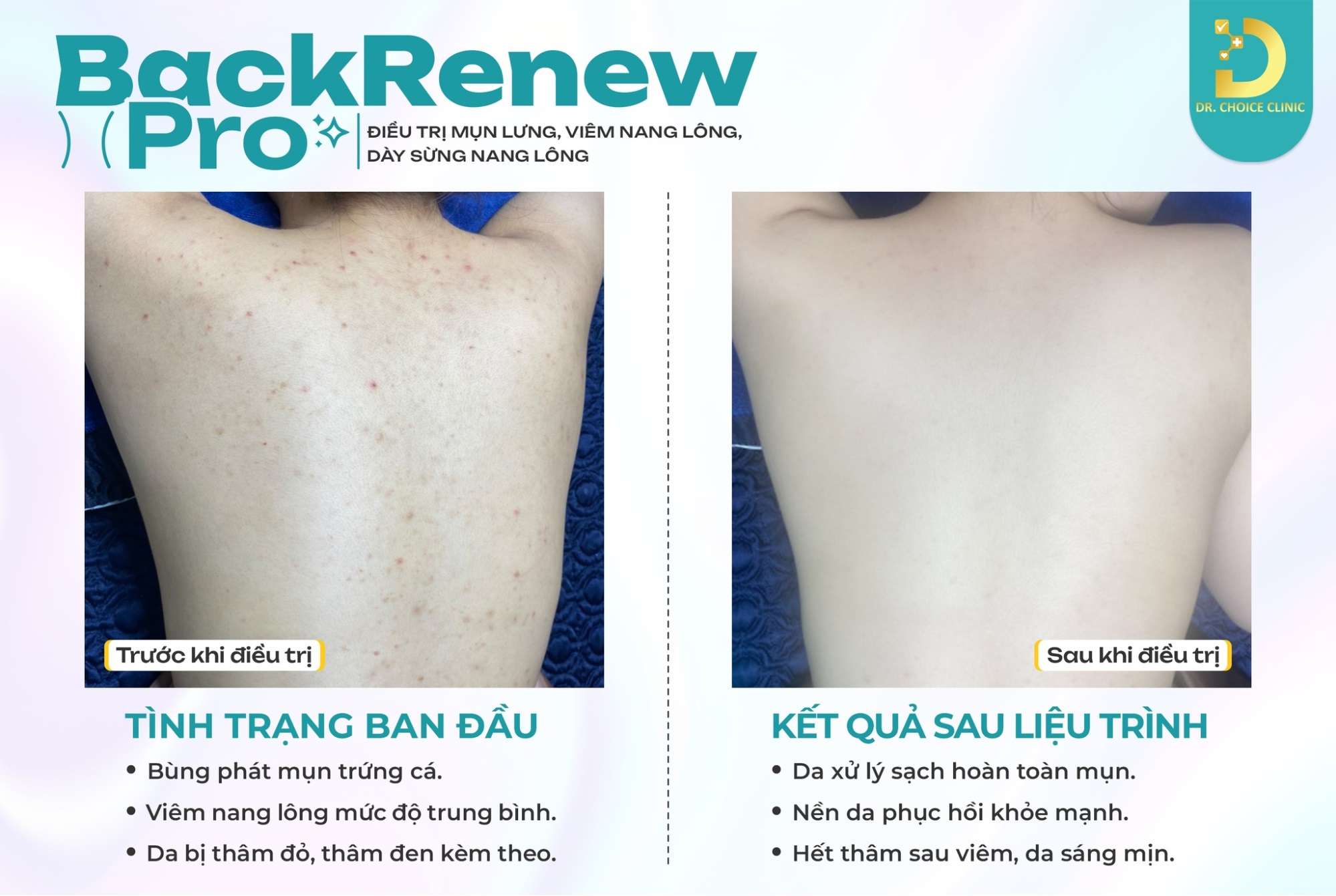 Mụn Đầu Đen & Sợi Bã Nhờn: Phân Biệt Để Điều Trị Hiệu Quả 23 Địa chỉ nào điều trị mụn đầu đen an toàn, hiệu quả HCM?