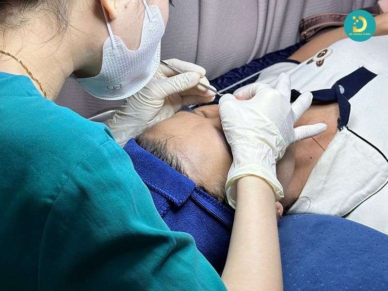 Mụn Đầu Đen & Sợi Bã Nhờn: Phân Biệt Để Điều Trị Hiệu Quả 19 Điều trị mụn đầu đen tại spa/clinic: khi nào nên áp dụng?