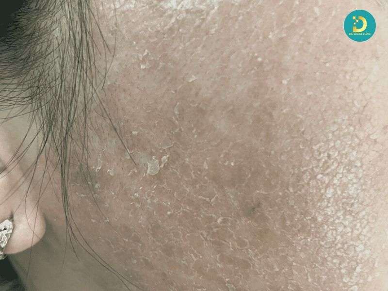 Mụn Đầu Đen & Sợi Bã Nhờn: Phân Biệt Để Điều Trị Hiệu Quả 21 Dùng treatment mạnh không phù hợp loại da