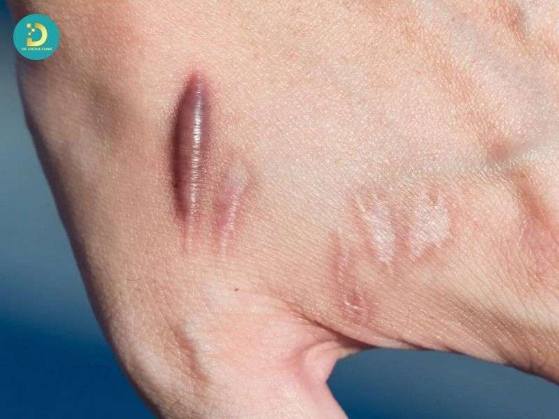 Sản Phẩm Trị Sẹo Lồi: Công Dụng, Hiệu Quả, Các Loại, Có Nên Dùng? 18 Khi nào KHÔNG nên chỉ điều trị sẹo lồi bằng sản phẩm tại nhà?