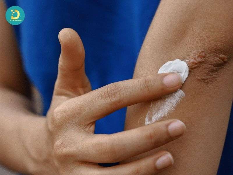 Sản Phẩm Trị Sẹo Lồi: Công Dụng, Hiệu Quả, Các Loại, Có Nên Dùng? 15 Kỹ thuật bôi/đắp sản phẩm đúng cách