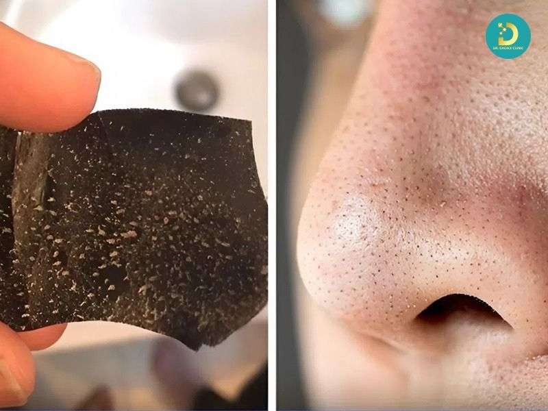 Mụn Đầu Đen & Sợi Bã Nhờn: Phân Biệt Để Điều Trị Hiệu Quả 20 Lạm dụng miếng lột mụn và tẩy tế bào chết