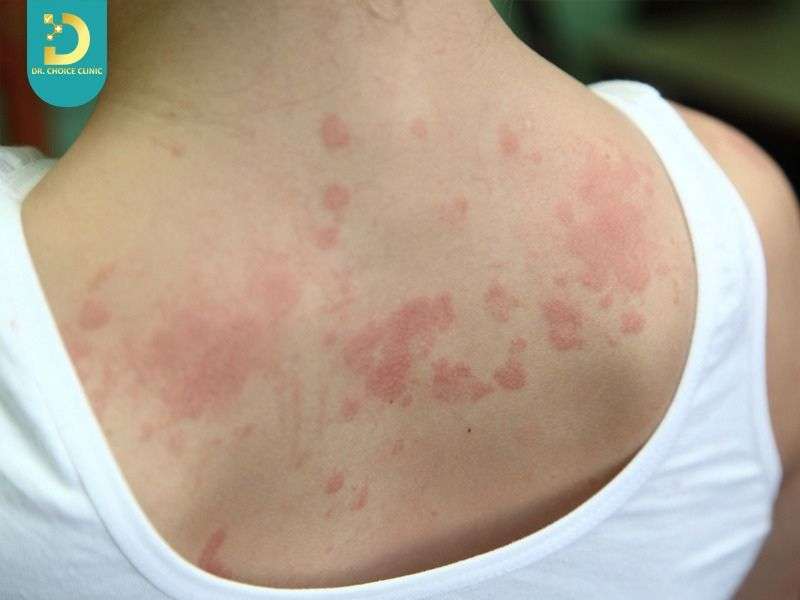 Viêm Da Tiếp Xúc Có Tự Khỏi Không? Cách Điều Trị Tại Nhà Hiệu Quả 20 Lạm dụng thuốc bôi corticoid gây hậu quả gì?