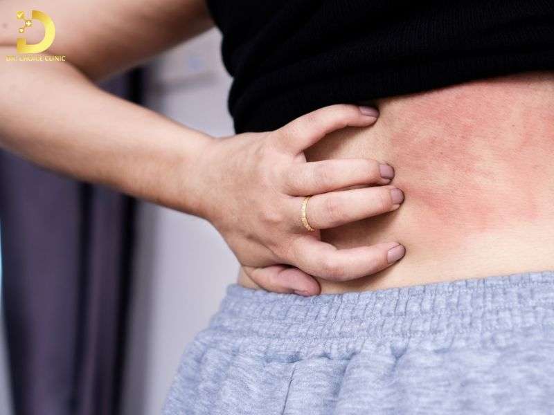 Lưu ý gì khi tự điều trị viêm da cơ địa tại nhà?