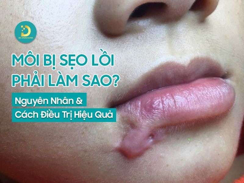 Môi Bị Sẹo Lồi Phải Làm Sao? Nguyên Nhân & Cách Điều Trị Hiệu Quả 11 Môi bị sẹo lồi phải làm sao?