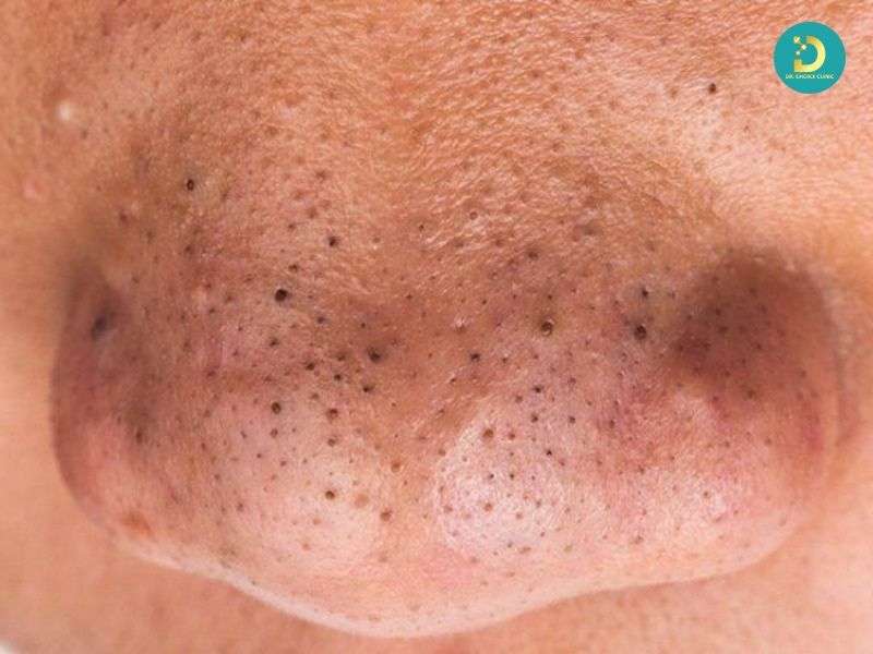 Mụn Đầu Đen & Sợi Bã Nhờn: Phân Biệt Để Điều Trị Hiệu Quả 14 Mụn đầu đen là gì?