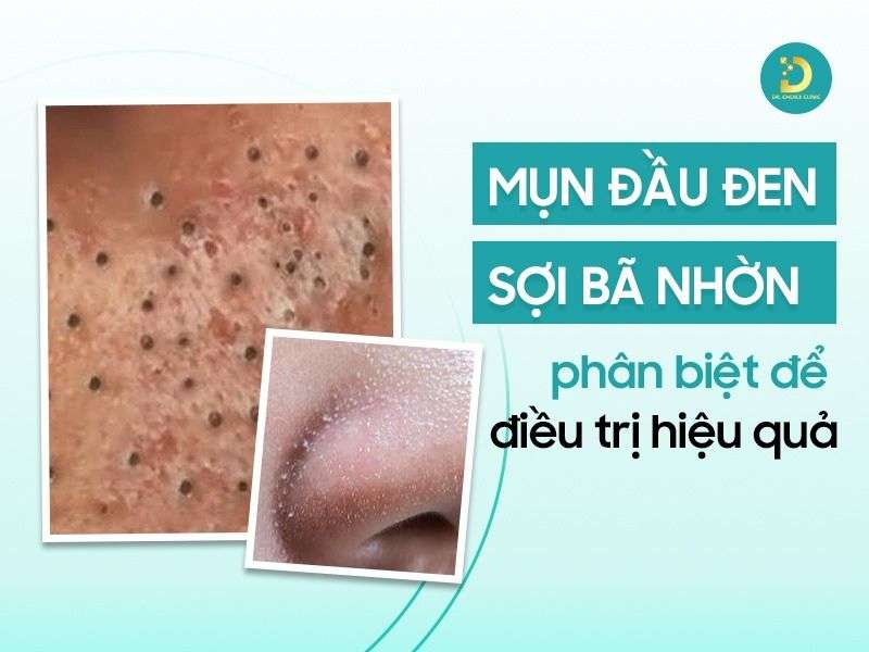 Mụn Đầu Đen & Sợi Bã Nhờn: Phân Biệt Để Điều Trị Hiệu Quả 13 Mụn đầu đen & sợi bã nhờn