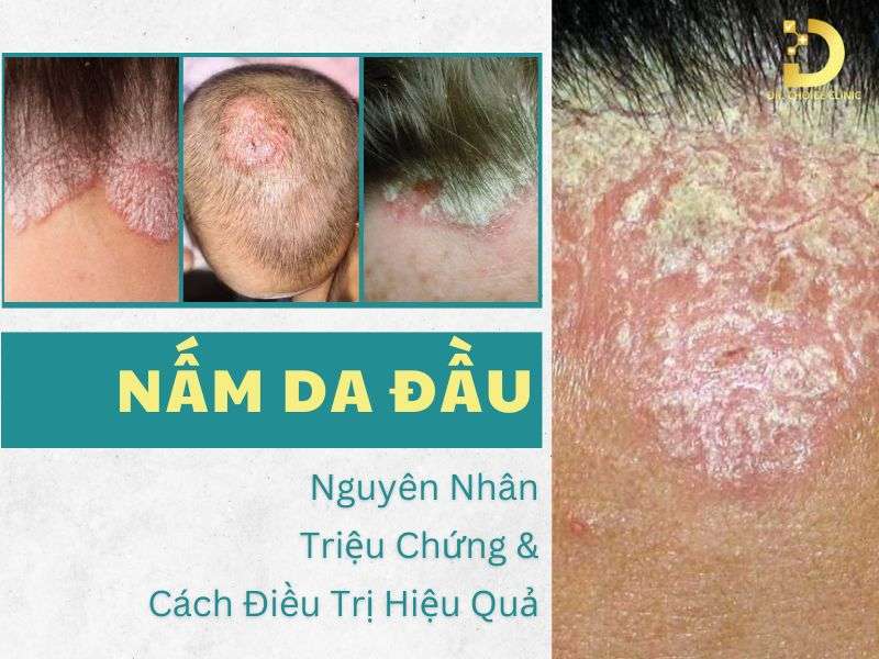 Nấm Da Đầu: Nguyên Nhân, Triệu Chứng & Cách Điều Trị Hiệu Quả 6 Nấm da đầu