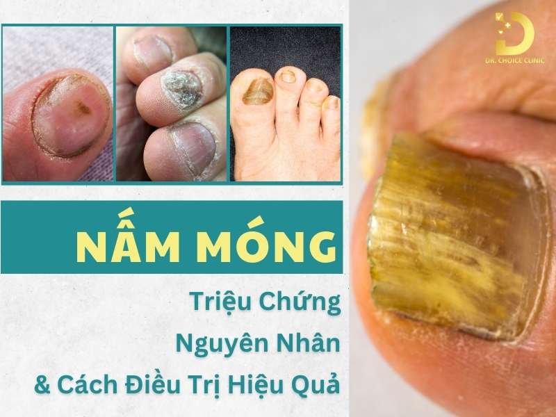Nấm Móng: Triệu Chứng, Nguyên Nhân & Cách Điều Trị Hiệu Quả 7 Nấm móng